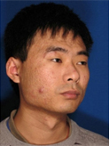 Patient # 36624 Before Photo # 1